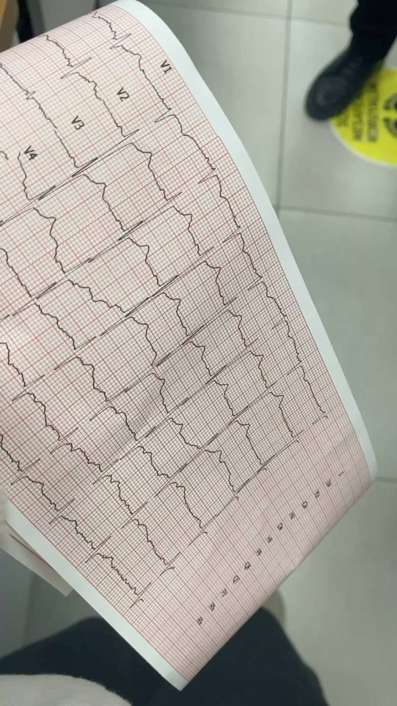 Real EKG Strip